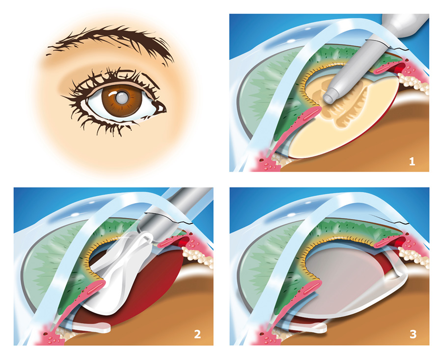 Cataract Surgery Graphic